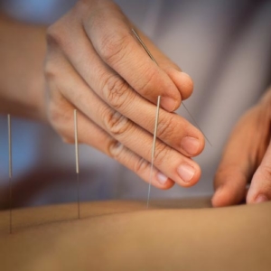 TRADITIONAL ACUPUNCTURE & DRY NEEDLING